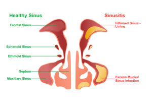 Sinusitis Effects - Sinusitis Australia